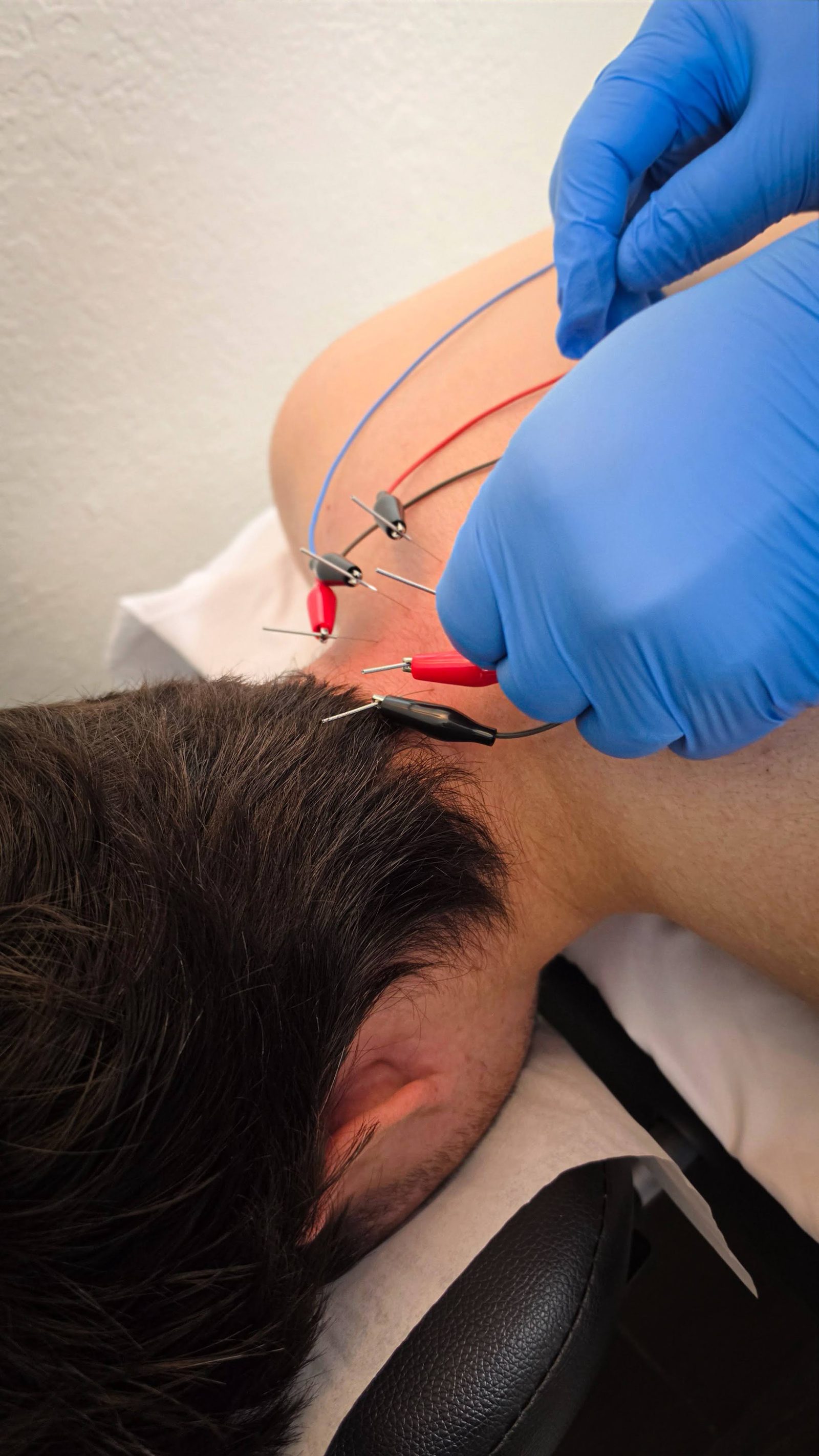 Dry needling with electric stim at Stewart Clinic of Chiropractic